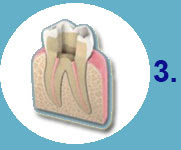 Cómo se hace una endodoncia - Clínica Dental Díez - tu dentista de confianza en Madrid Legazpi