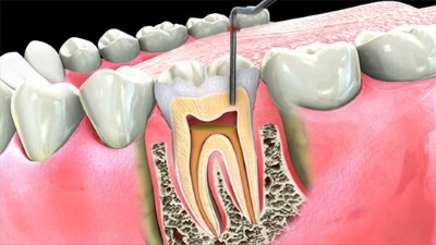 Especialistas en endodoncia en Clínica Dental Díez - tu dentista de confianza en Madrid Legazpi