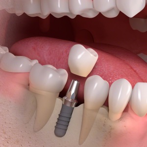 Implantes dentales unitarios en Clínica Dental Díez - tu dentista de confianza en Madrid Legazpi