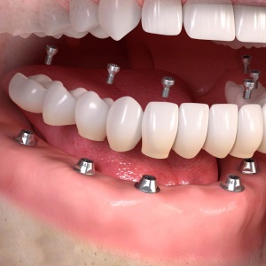 Implantes dentales arcada completa en Clínica Dental Díez - tu dentista de confianza en Madrid Legazpi