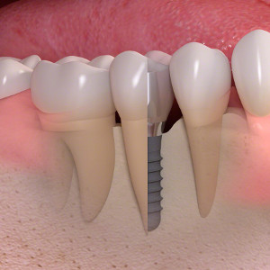 Implantes dentales en Madrid Legazpi Clínica Dental Díez