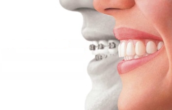 Especialistas en ortodoncia Invisible en Madrid Legazpi